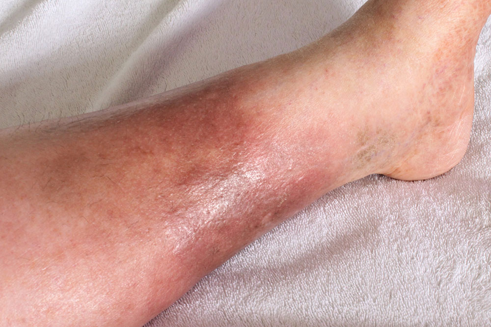 12 Common Deep Vein Thrombosis Risk Factors