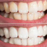 4 Simple Ways to Whiten Teeth Naturally