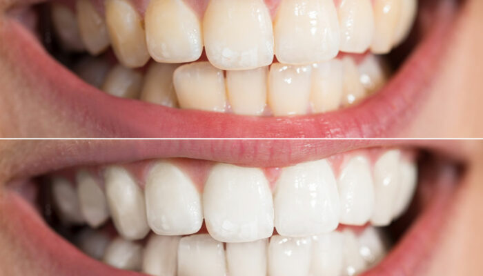 4 Simple Ways to Whiten Teeth Naturally