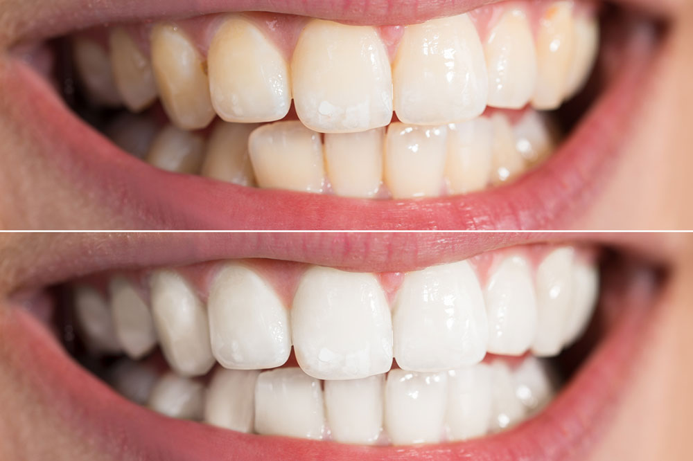 4 Simple Ways to Whiten Teeth Naturally