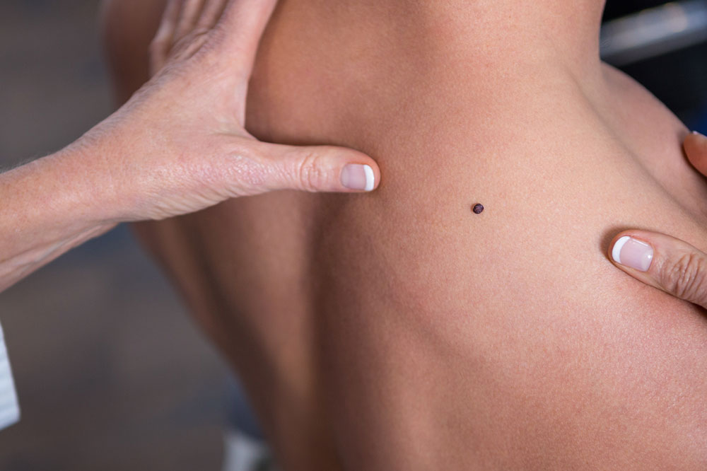 5 Common Signs of Melanoma